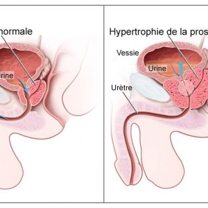 Hyperplasie de la prostate, prostatite : cette nouvelle thérapie peut aider